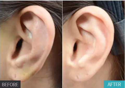 关于耳矫形，你必须知道的“1、2、3”